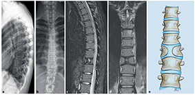Csigolyafejlődési rendelenesség - röntgen