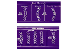 Csigolyafejlődési rendelenesség