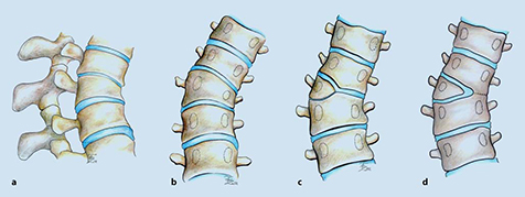 Csigolyafejlődési rendelenesség